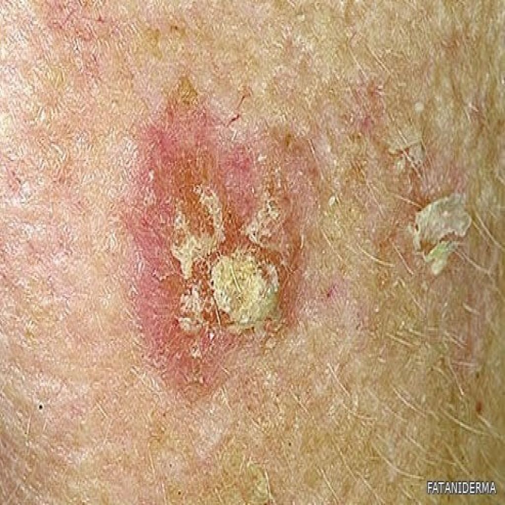 العوامل التي قد تزيد من خطر الإصابة بسرطان الجلد